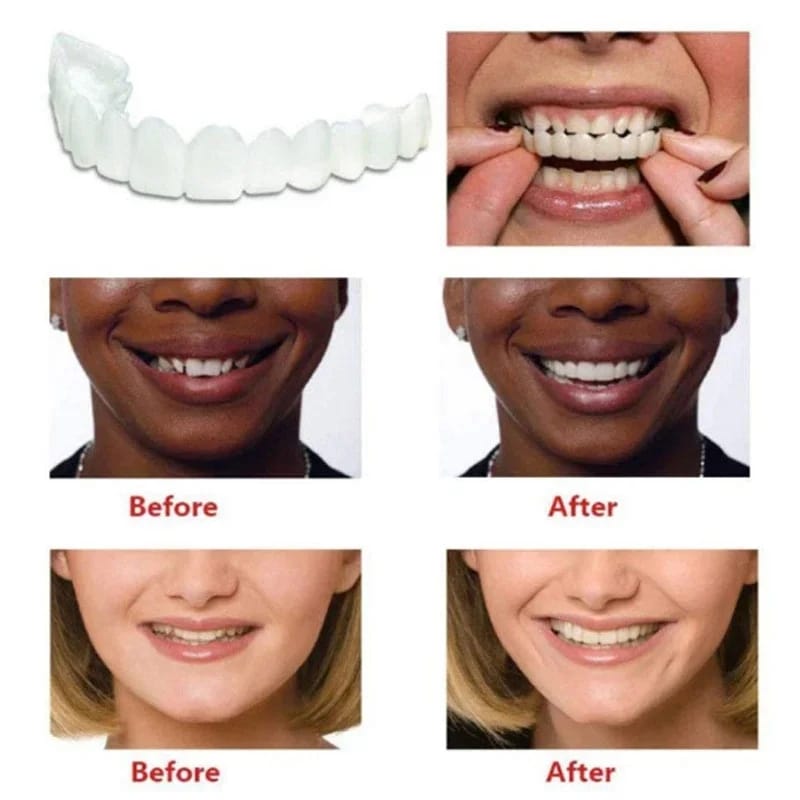 Montura Carillas dentales postizas